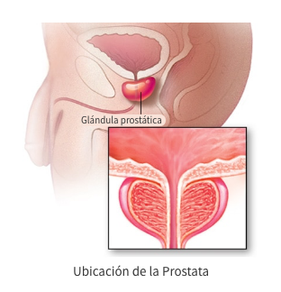 Cáncer de Próstata - 2
