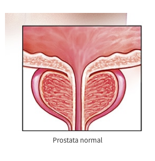 Cáncer de Próstata - 3